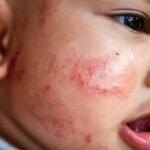 Atopik Dermatit (Egzama) Nedir?
