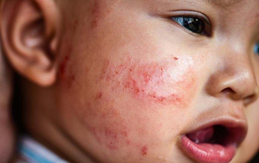 Atopik Dermatit (Egzama)