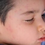 Ürtiker Nedir?