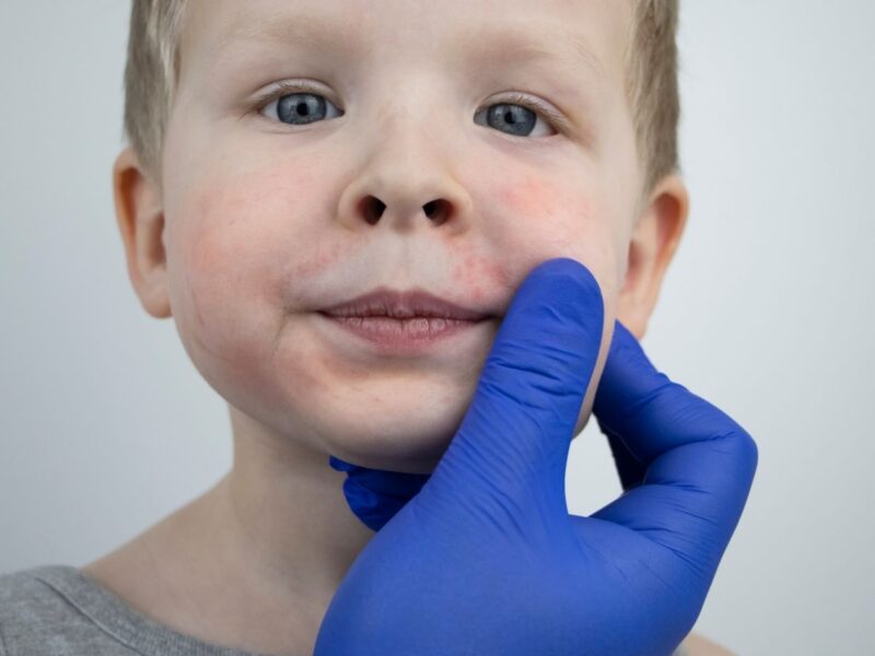 Bebek ve Çocuklarda Egzama (Atopik Dermatit)