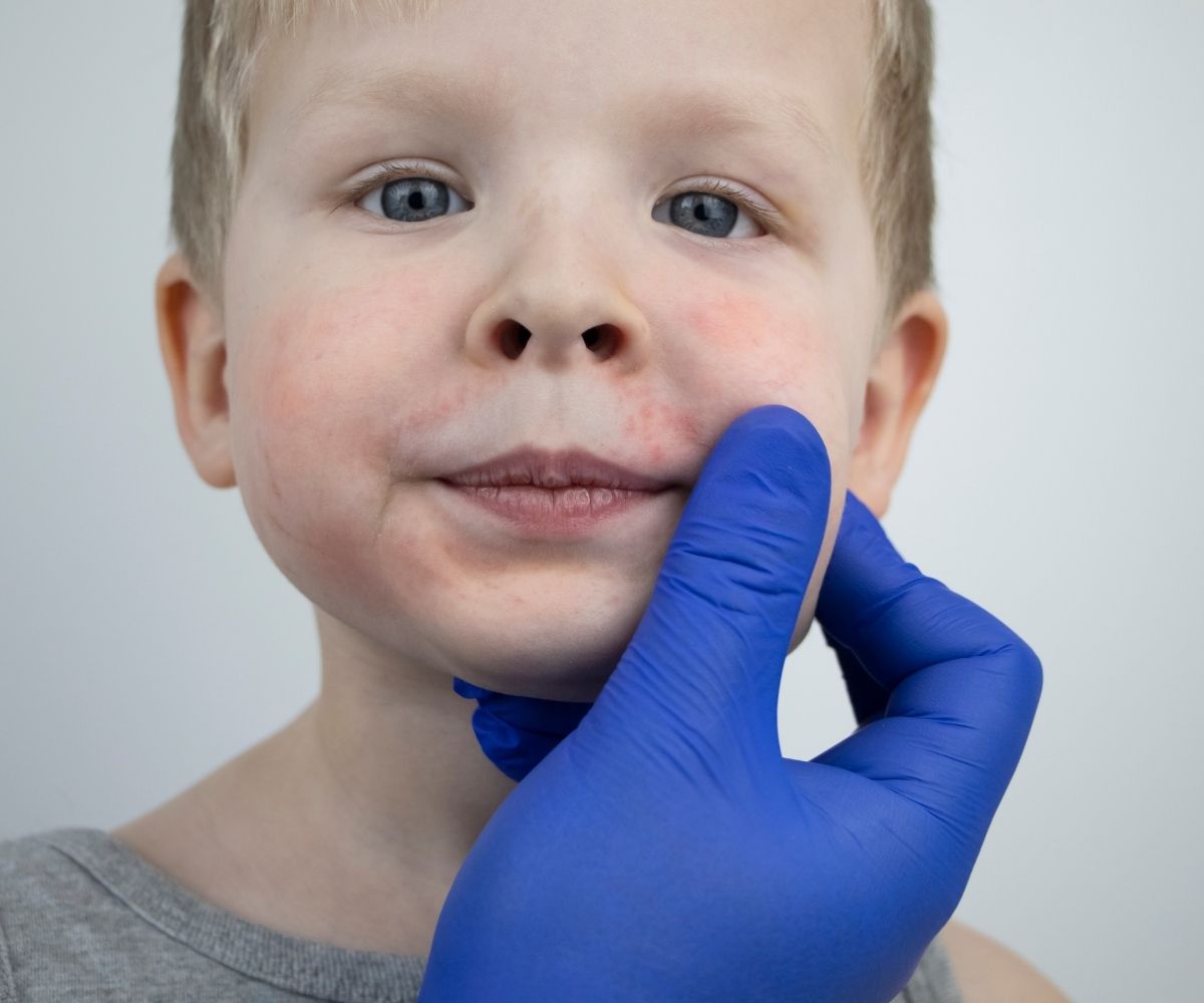 Bebek ve Çocuklarda Egzama (Atopik Dermatit)