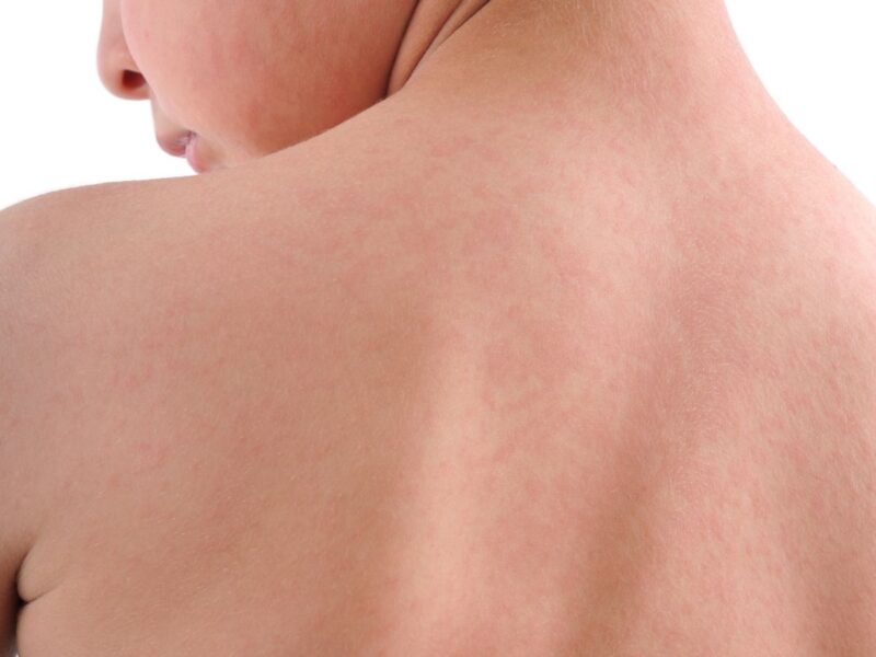 Bebek ve Çocuklarda Kurdeşen (Ürtiker)