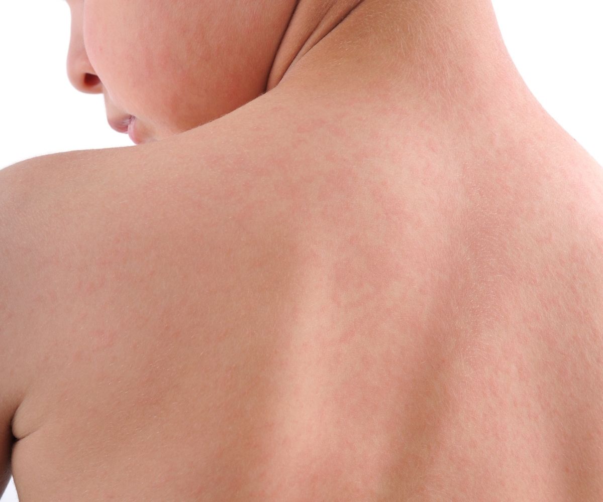 Bebek ve Çocuklarda Kurdeşen (Ürtiker)