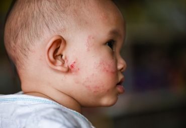 Bebek ve Çocuklarda Egzama